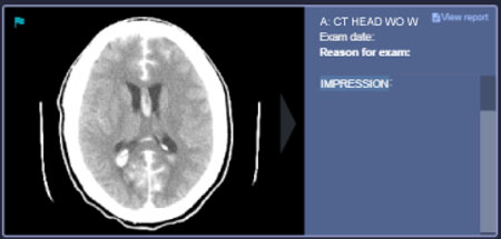 A study card in Story View: CT head image beside the exam details and impression